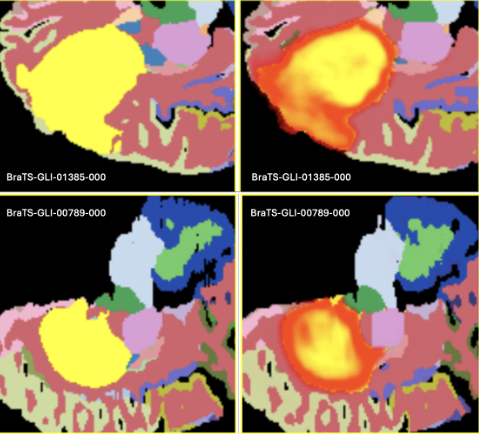 Brain tumor segmentation case